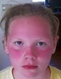 Violet Michener was severely sun burned as a result of her schools silly no sun tan lotion policy